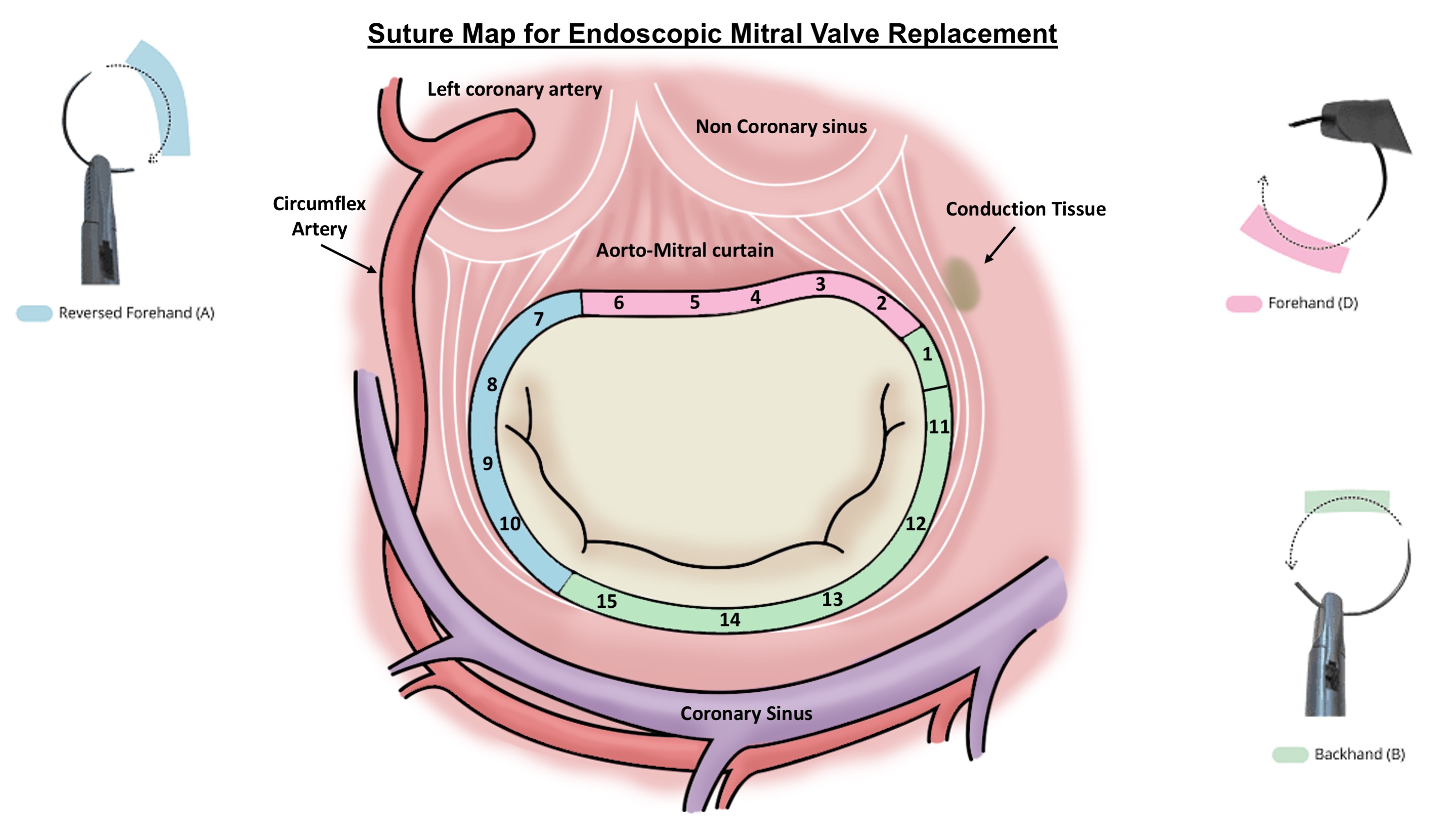 Suture map for endoscopic mitral valve replacement | MMCTS